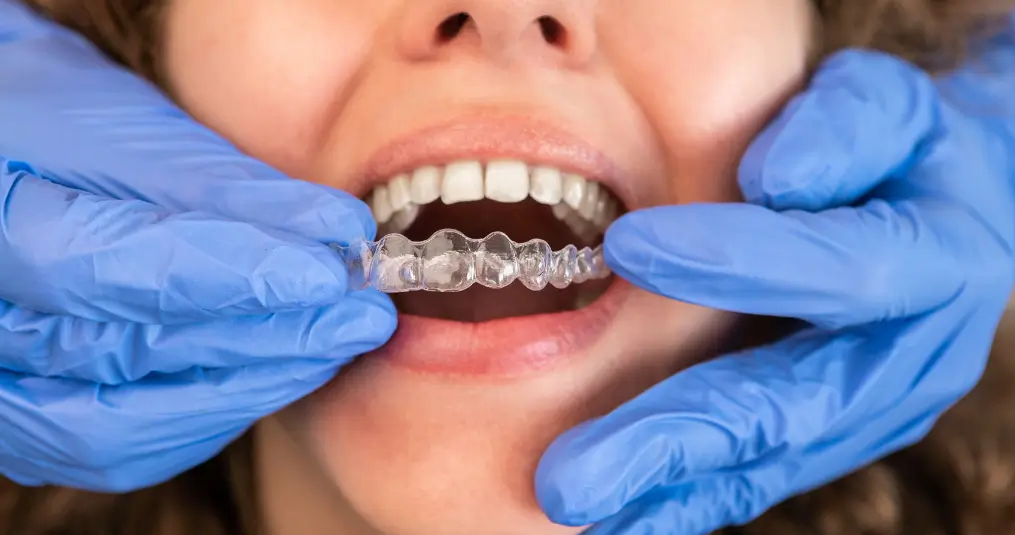 aparelho-invisalign-doctor-dra-patricia-mandarino