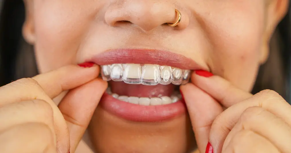 aparelho-invisalign