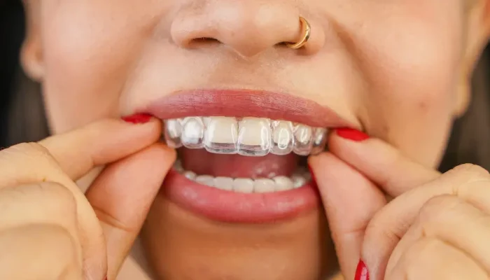aparelho-invisalign