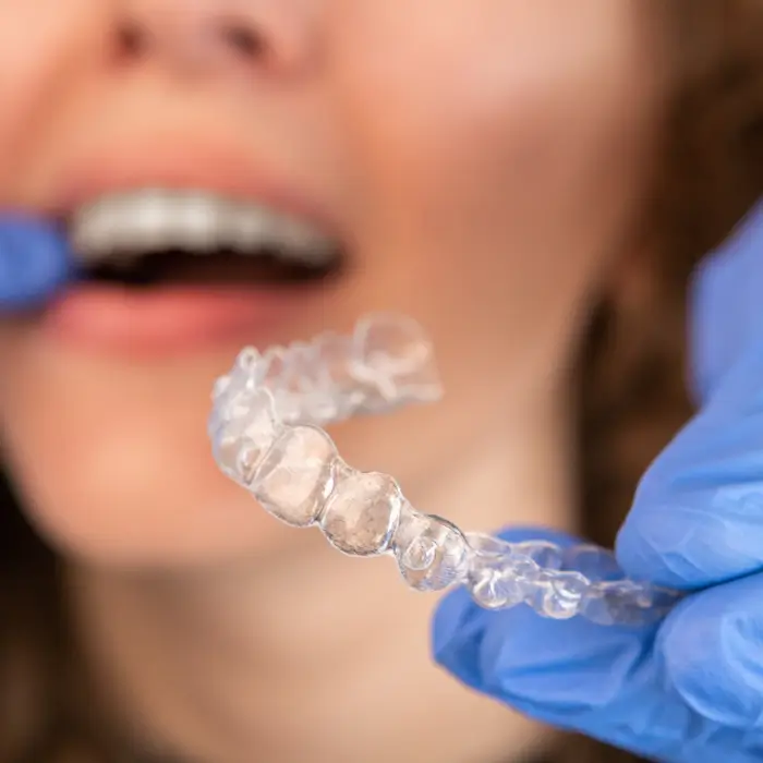 o-que-e-o-invisalign